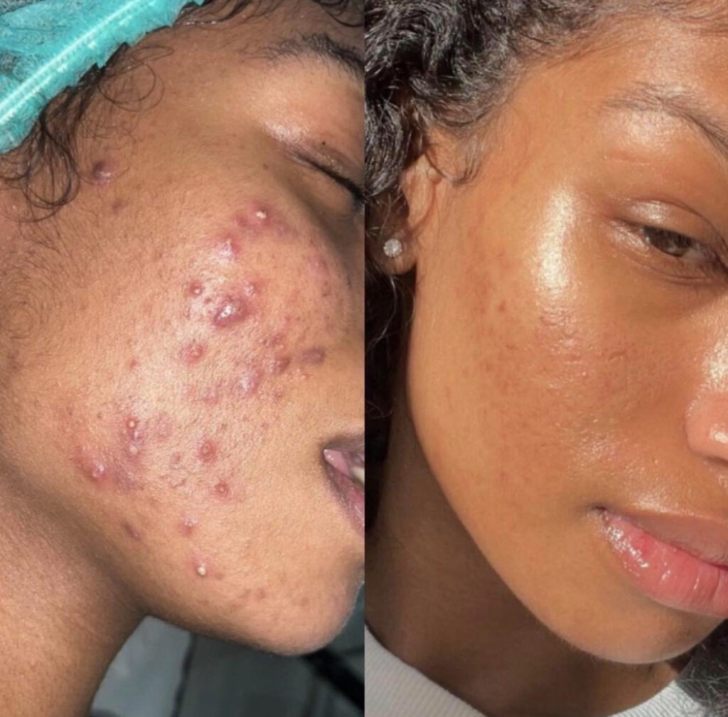 IMG 8572 Anelle Aesthetics Launches Exclusive Corporate Packages in Colmore Business District